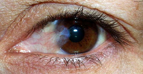 Pterigium en los ojos